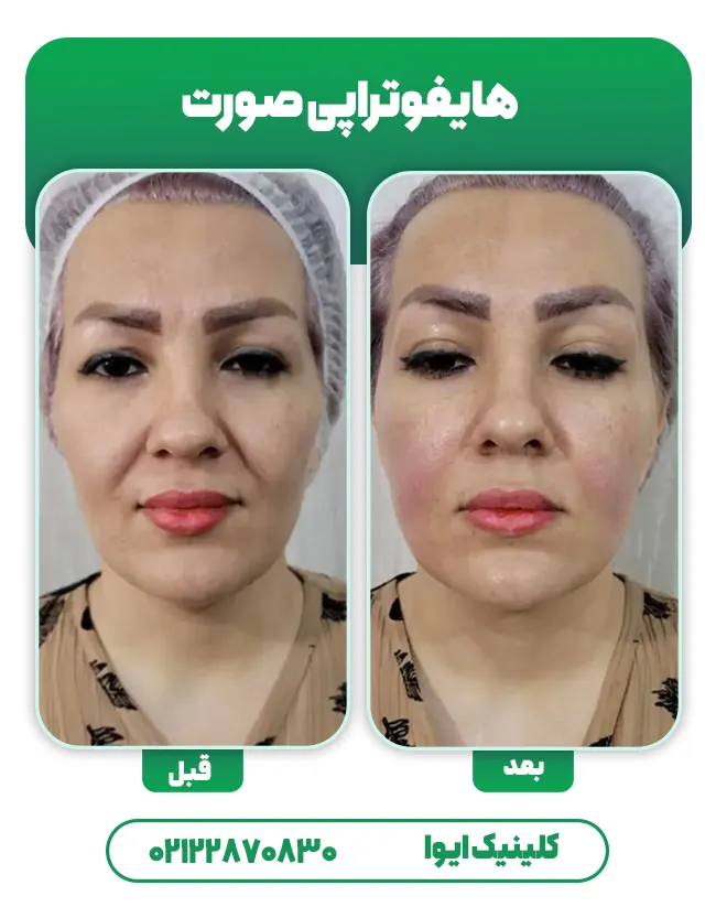 هایفوتراپی صورت