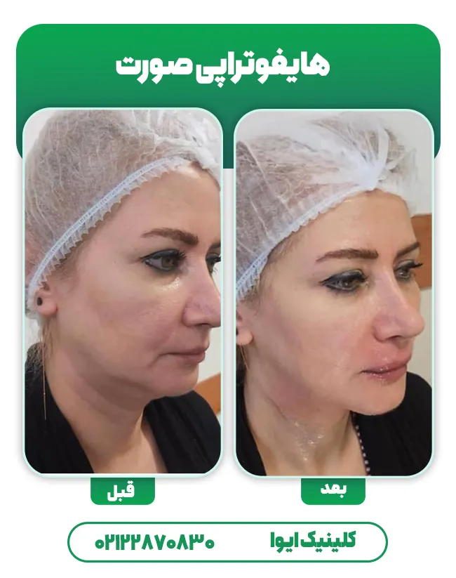 هایفوتراپی صورت
