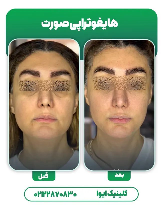 هایفوتراپی صورت