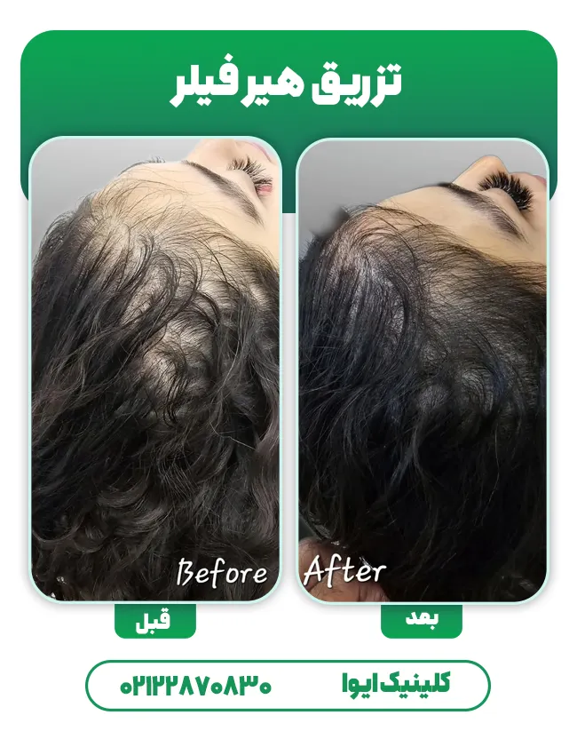 درمان ریزش مو با هیر فیلر