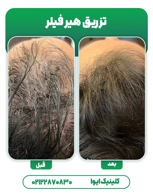 درمان ریزش مو با هیر فیلر