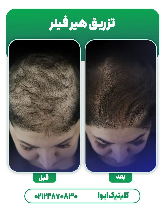 درمان ریزش مو با هیر فیلر