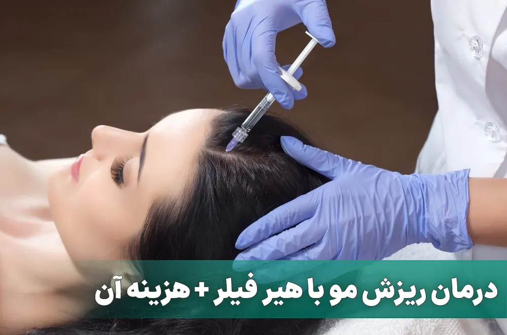 درمان ریزش مو با هیر فیلر