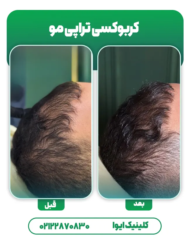 کربوکسی تراپی مو