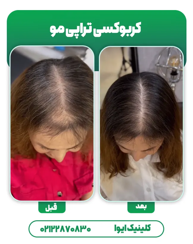 کربوکسی تراپی مو