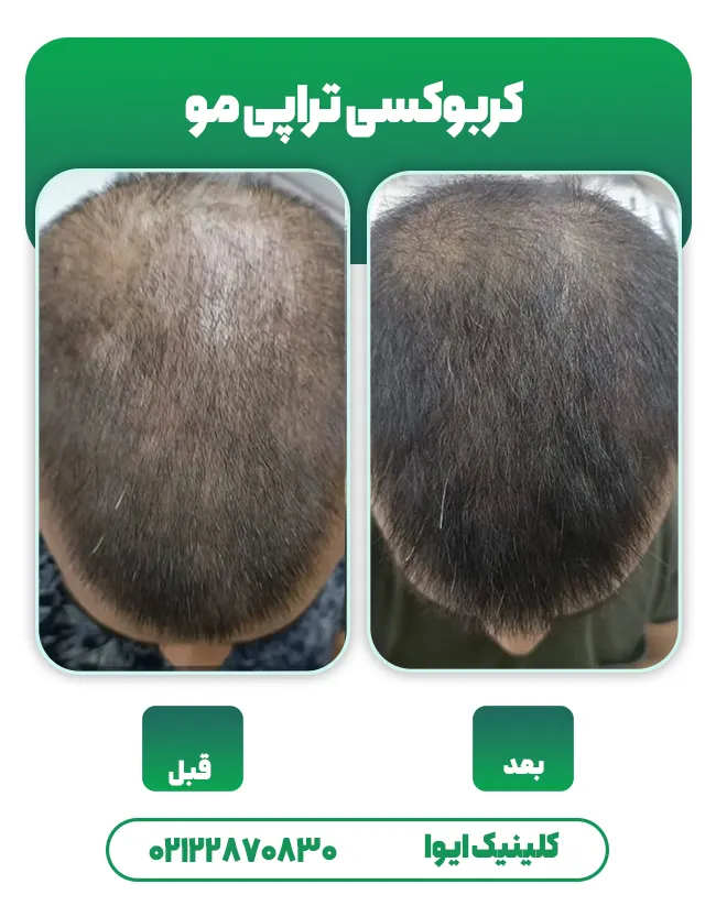 کربوکسی تراپی مو