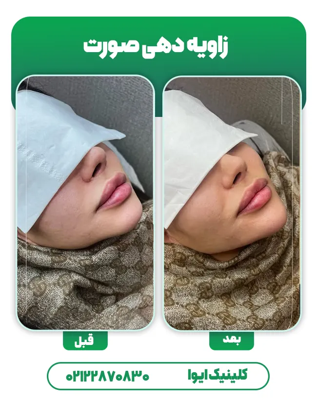 زاویه سازی صورت