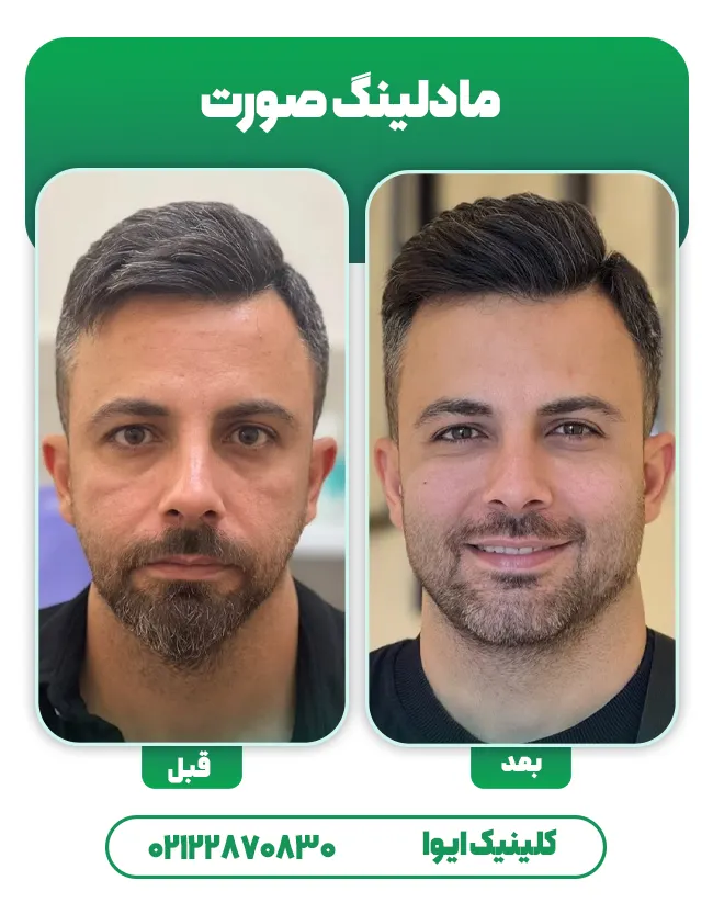 مادلینگ صورت