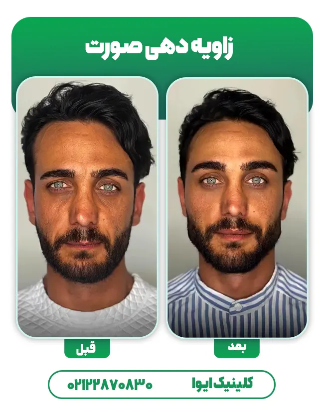 زاویه دهی به صورت