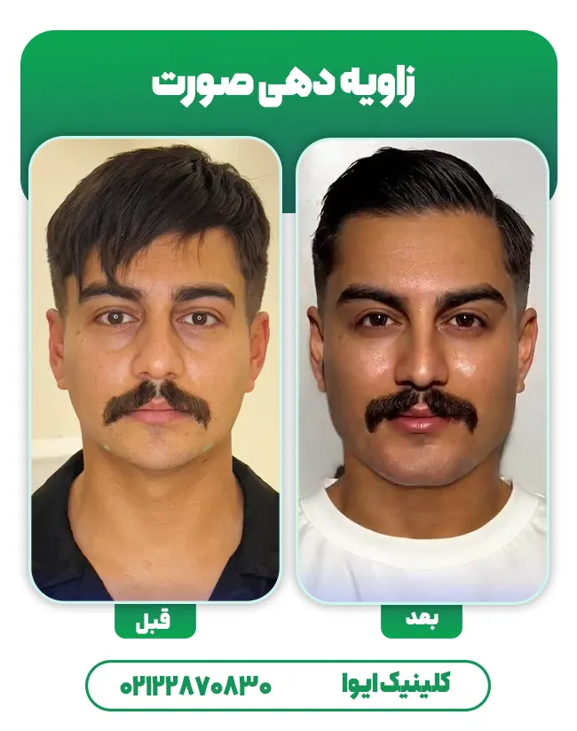 زاویه سازی صورت با فیلر