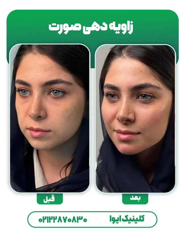 متقارن سازی صورت با ژل