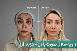 زاویه سازی صورت با ژل