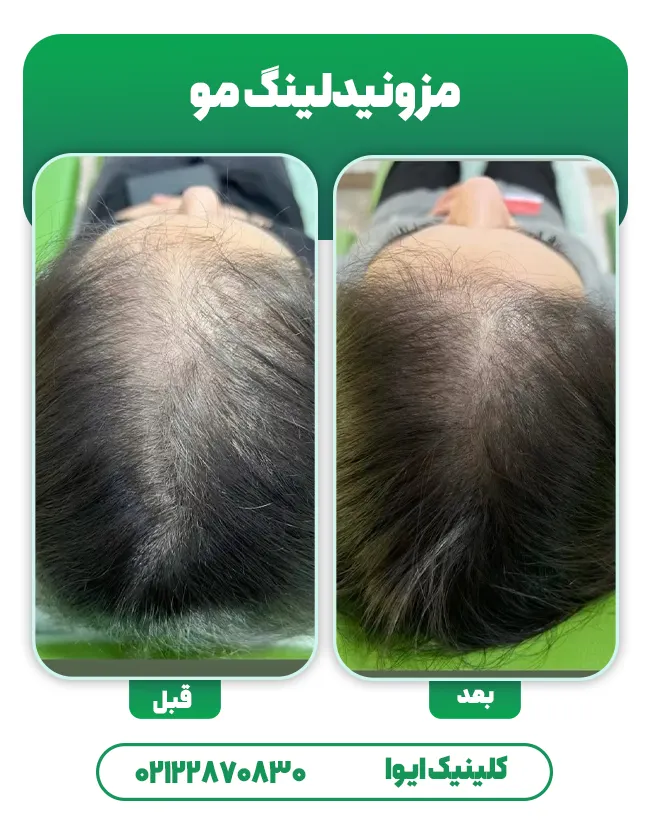 درمان ریزش مو با مزونیدلینگ مو