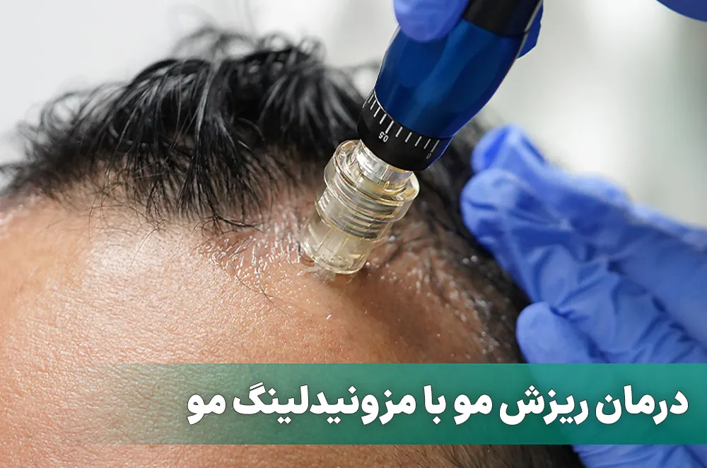 مزونیدلینگ مو