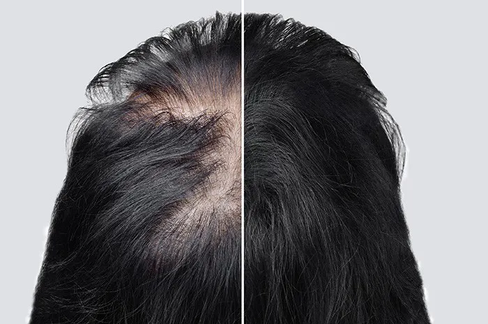 درمان ریزش -مو با مزونیدلینگ