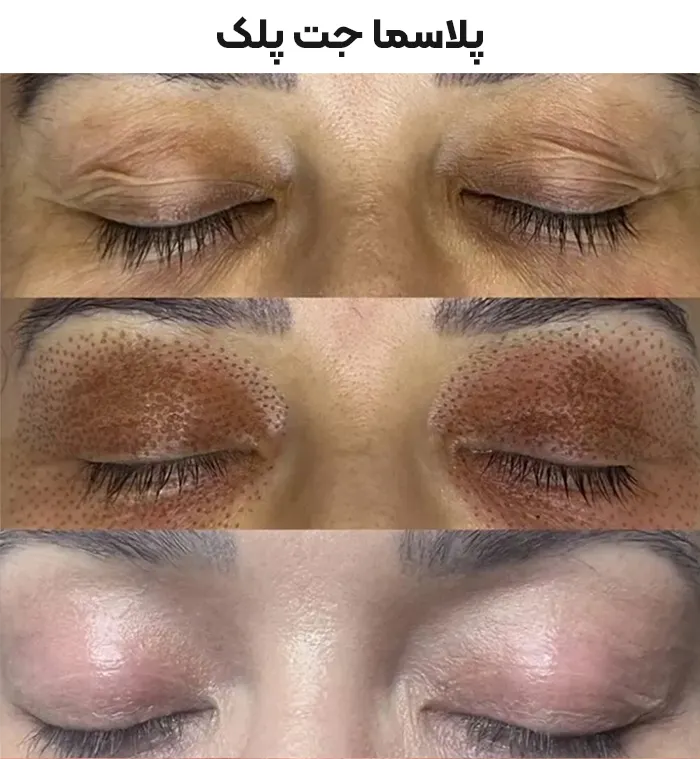 پلاسما جت پلک