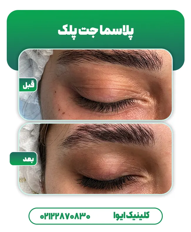 پلاسما جت پلک