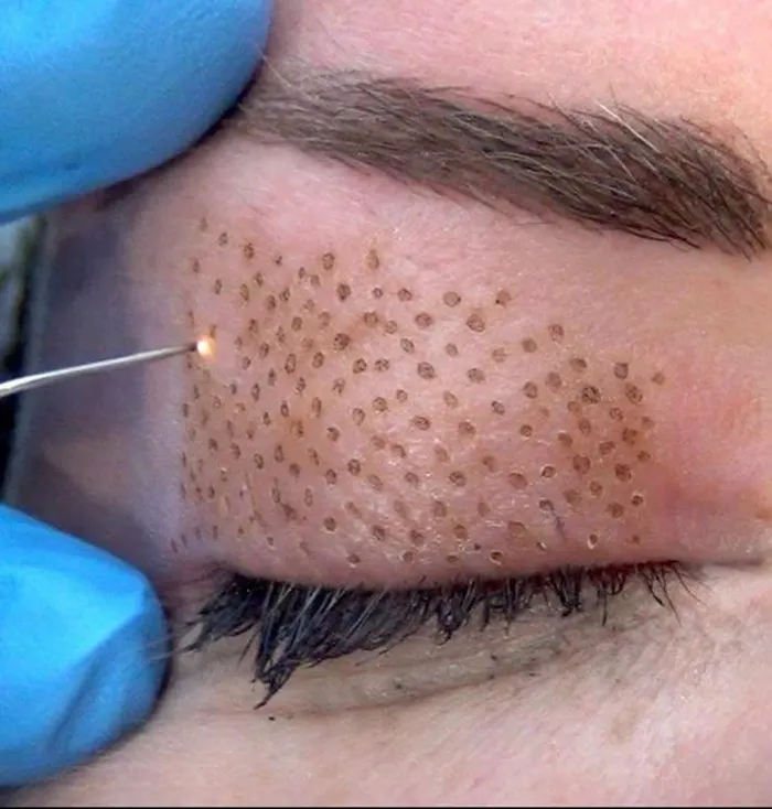 پلاسما جت پلک