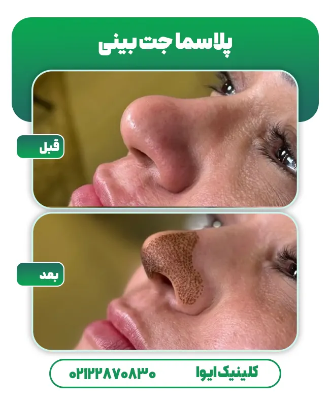 پلاسما جت بینی