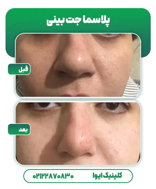 پلاسما جت بینی