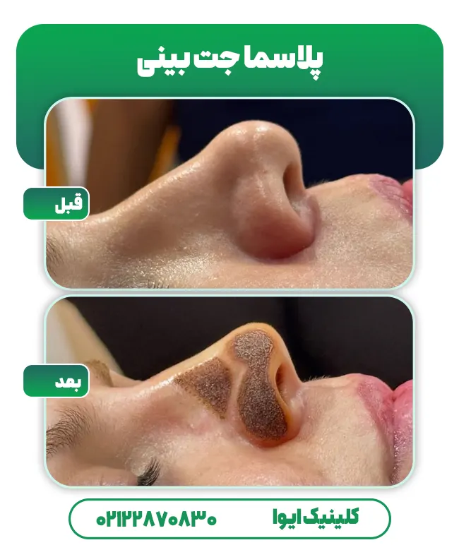 پلاسما جت بینی