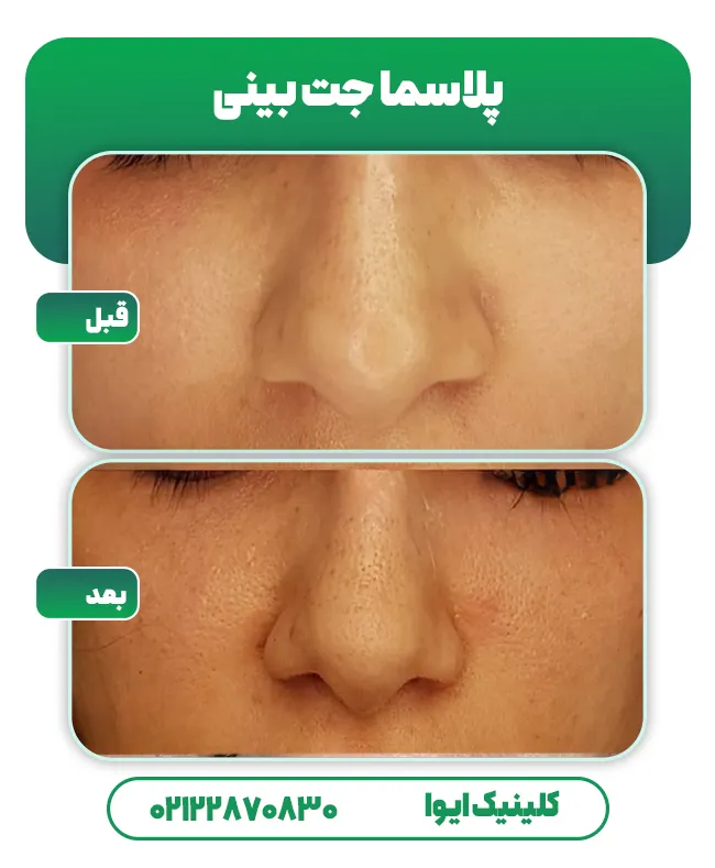 پلاسما جت بینی