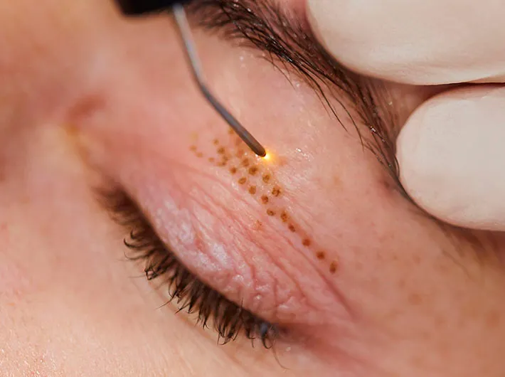 پلاسما جت پلک