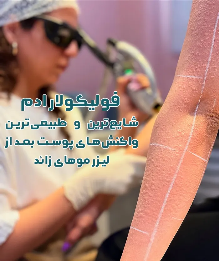 فولیکولار ادم
