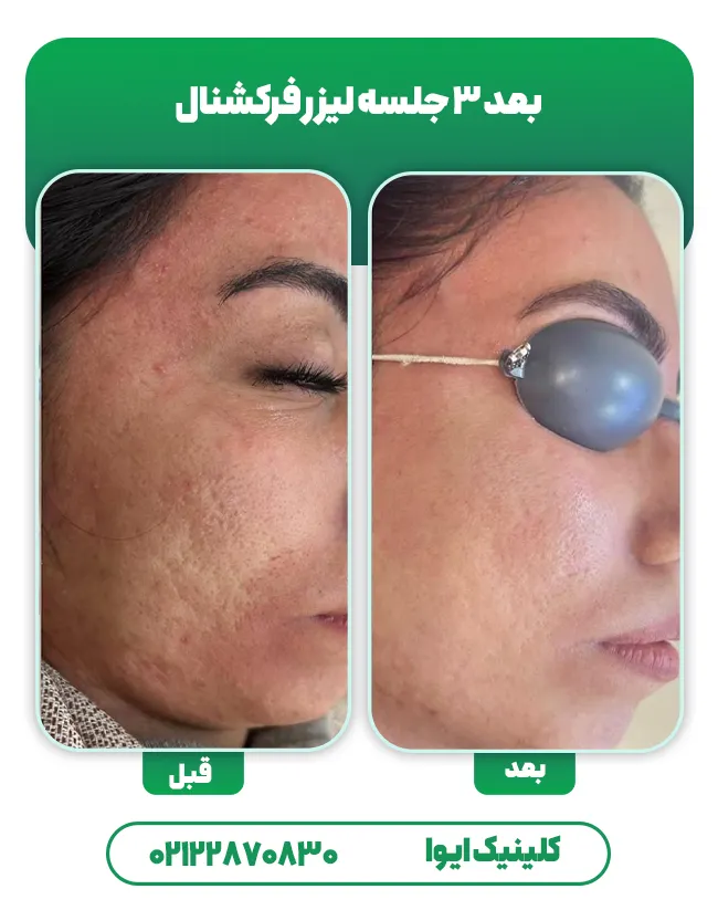 لیزر co2 جای جوش