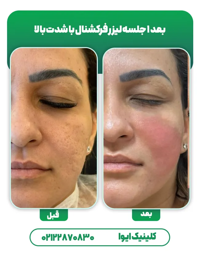 لیزر co2 جای جوش