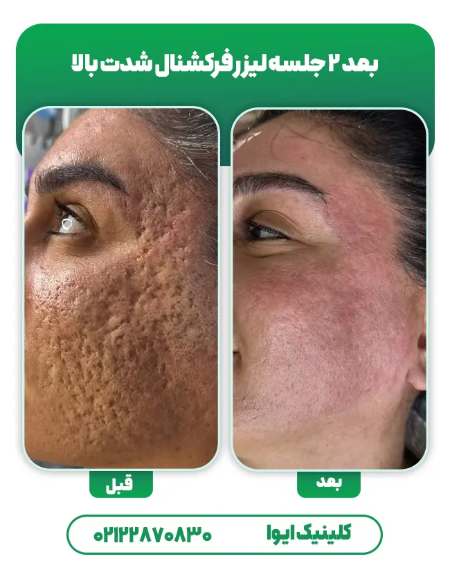 لیزر co2 جای جوش