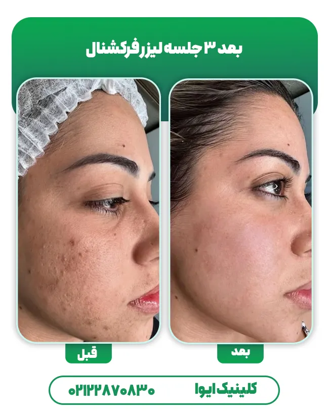 لیزر co2 جای جوش