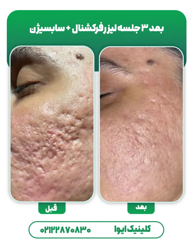 لیزر جای جوش صورت