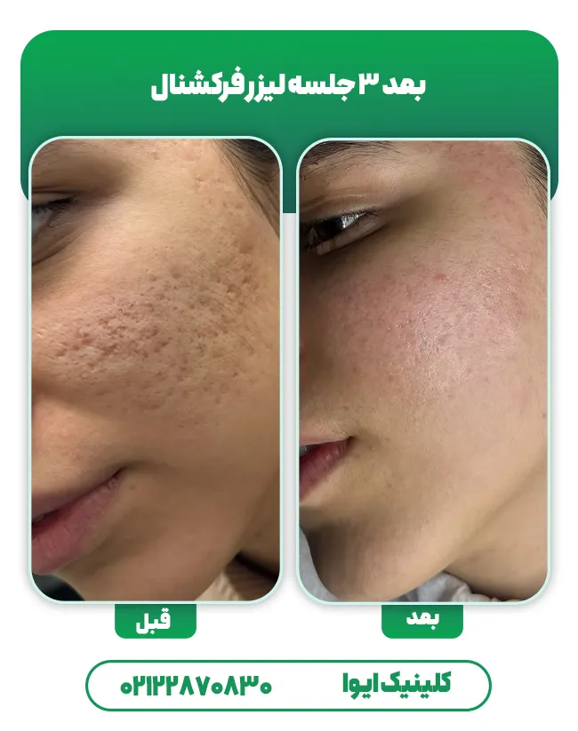 لیزر co2 اسکار جوش فرورفته