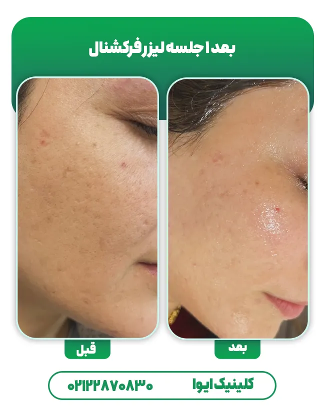 لیزر co2 جای جوش