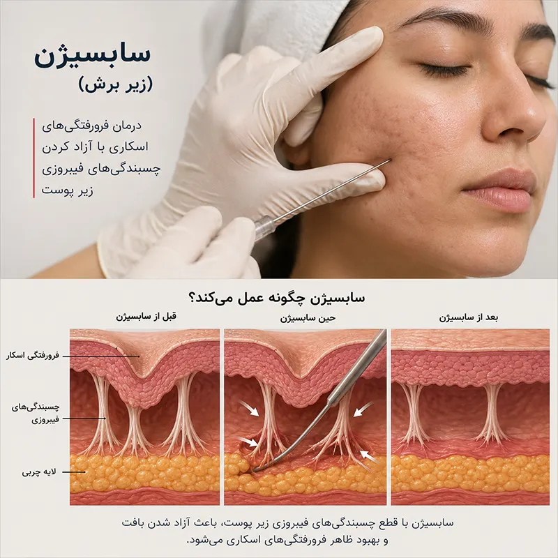 سابسیژن چیست؟