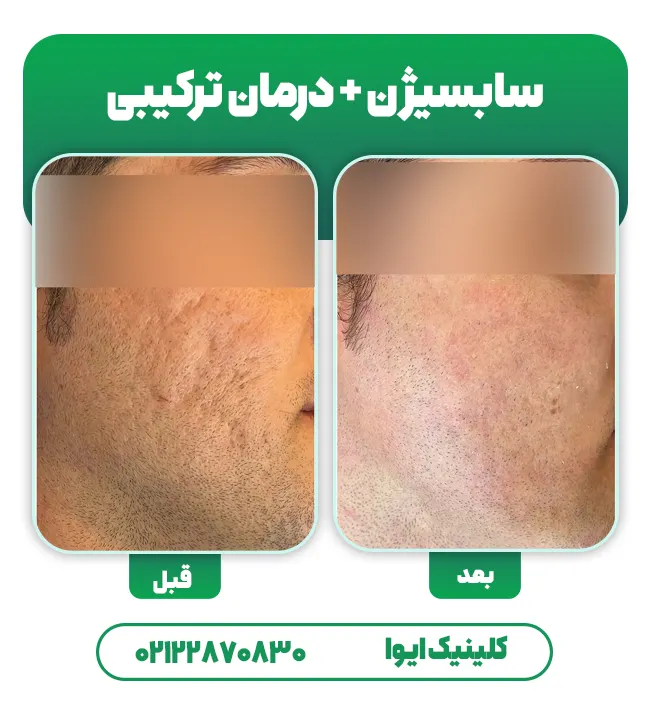 قبل بعد سابسیژن جای جوش