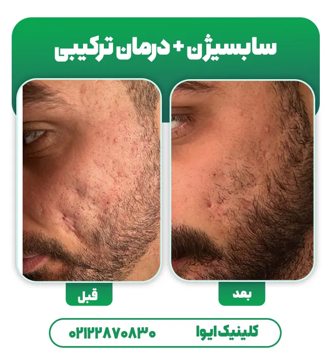 قبل بعد سابسیژن پوست