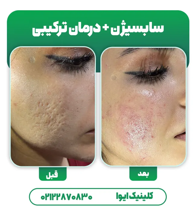 سابسیژن درمان اسکار