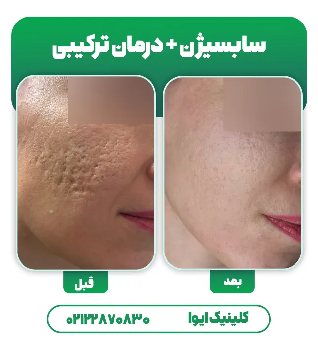 سابسیژن جای جوش