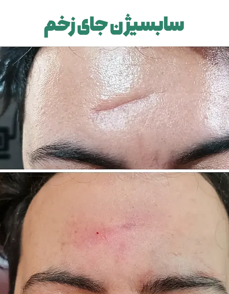سابسیژن جای زخم