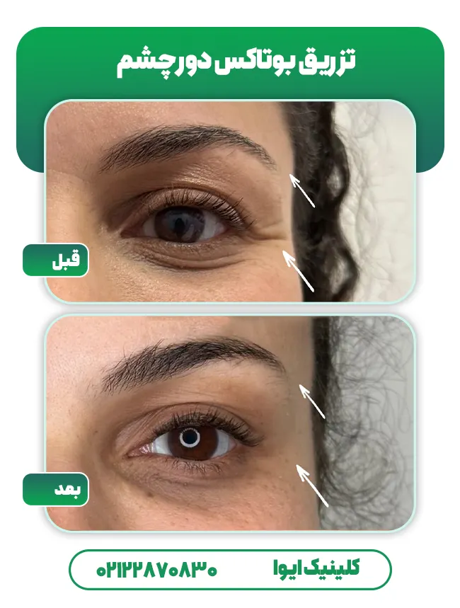 تزریق بوتاکس دور چشم