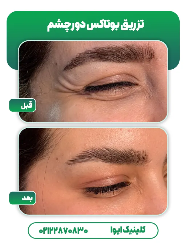 تزریق بوتاکس دور چشم
