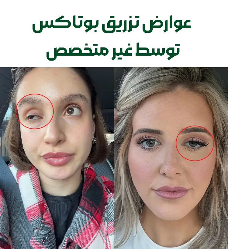عوارض تزریق بوتاکس دور چشم