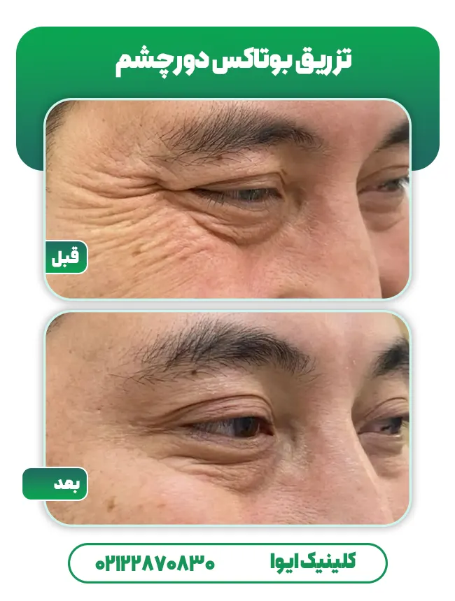 تزریق بوتاکس دور چشم