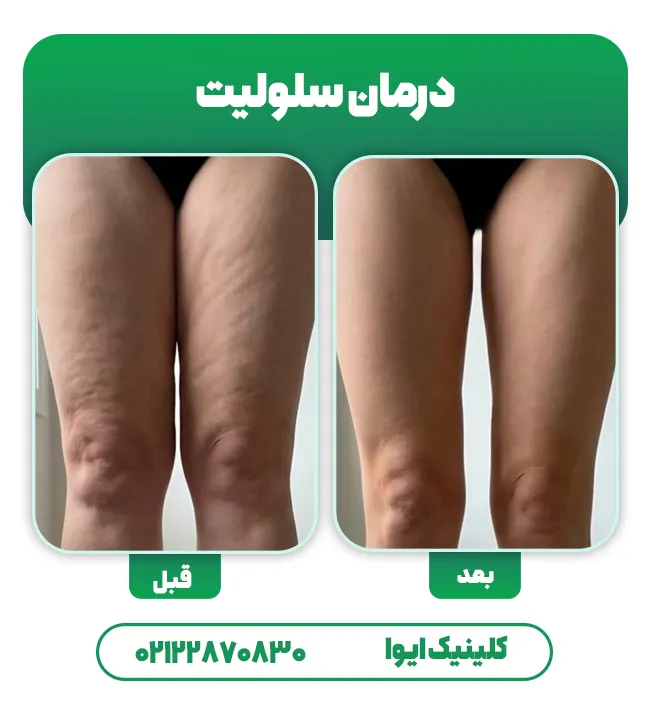 درمان سلولیت قبل بعد