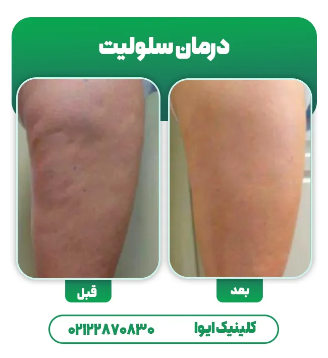 درمان سلولیت