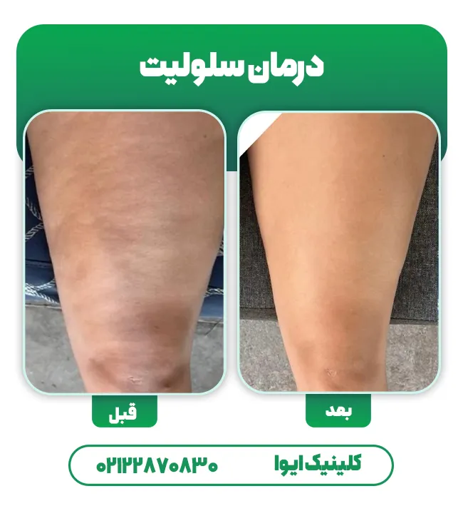 درمان سلولیت قبل بعد
