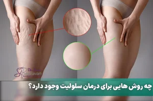 چه روش هایی برای درمان سلولیت وجود دارد؟