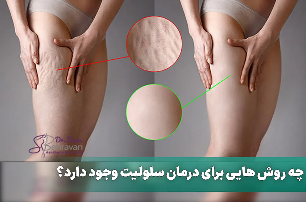 چه روش هایی برای درمان سلولیت وجود دارد؟